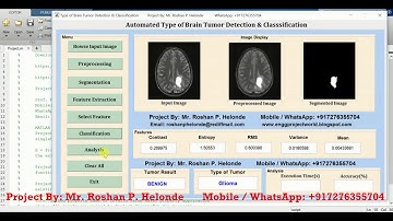 Type of Brain Tumor Detection and Classification Using Matlab Project Source Code