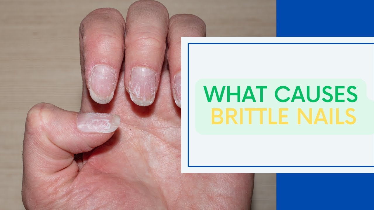 What Causes Brittle Nails YouTube