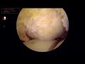 Course rotulienne pathologique sur antcdents de ttta et trochloplastie anciennes