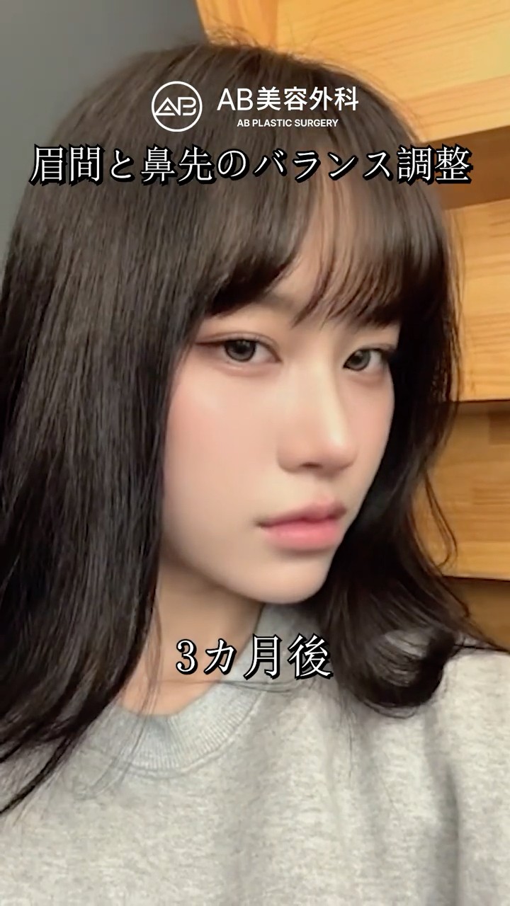 鼻再手術でここまで変わる？鼻先修正ビフォーアフター #shorts