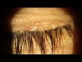 Demodex wax removal from eyelids for recurrent bacterial conjunctivitis