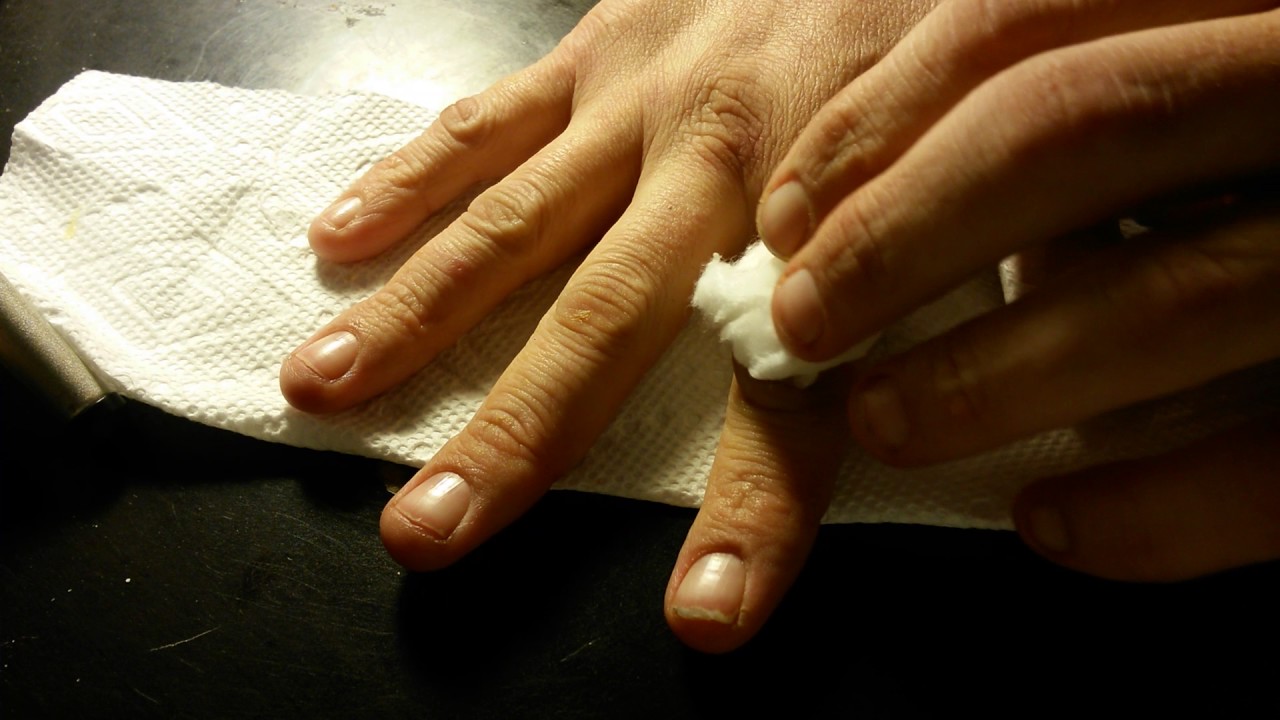 Cyst / boil removal from right finger. YouTube