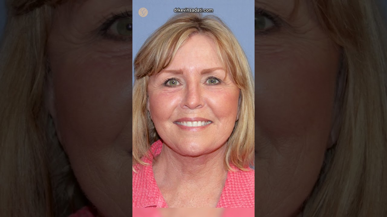 ⁣66-Year Young Facial Rejuvenation Transformation! #antiaging #cosmetic #aesthetic #plasticsurgeon