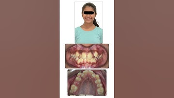 Why BaTR Braces Are Better than Robotic Braces | Custom Torque Made Simple