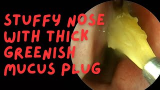 Stuffy Nose With Thick Greenish Mucus Plug