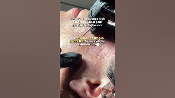 What is TCA Cross? #acnescars