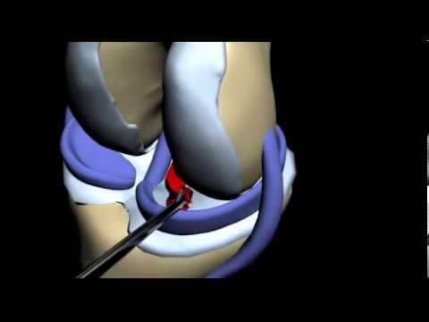 Мениск разрыв и операция