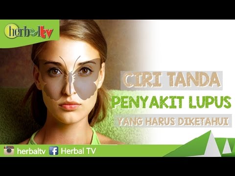 Ciri Tanda Penyakit Lupus yang Harus Diketahui Semua 