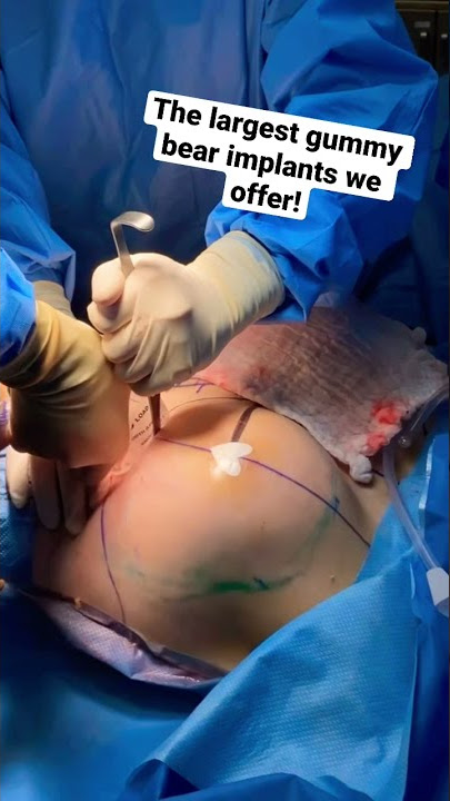 Transgender Breast Augmentation w/ 775cc Silicon Gummy Bear Implants- Plastic Surgery by Dr. Seattle