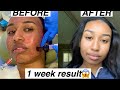 My First Microneedling Experience | Removes Acne Scars & Dark Spots| One Week Results