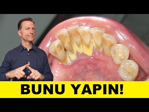 Diş Tartarını Önlemenin En İyi Yolu - Dr  Berg Türkçe