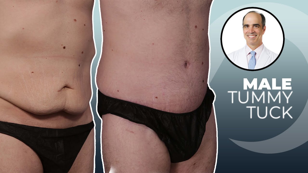 What to Expect from a Male Tummy Tuck