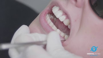 QuickSleeper in de praktijk