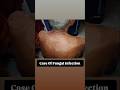 😱Tinea Prevention#medicine #skintoskincontact #skincondition #skindisease #youtubeshorts#brightskin