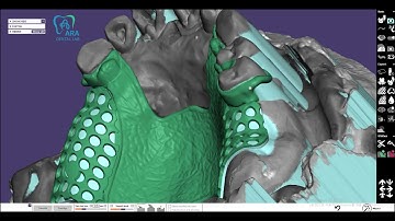partial frame design exocad (single palatal bar type)