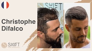 Christophe Difalco - A Hair Transplant Review with SHIFT Hair in Turkey Istanbul