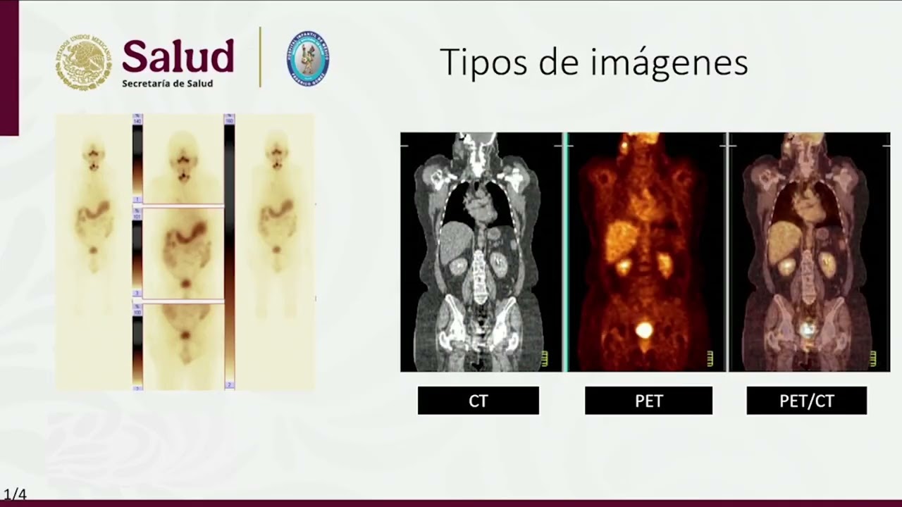 1  MEDICINA NUCLEAR EN EL DX Y TX DEL NIÑO CON CÁNCER