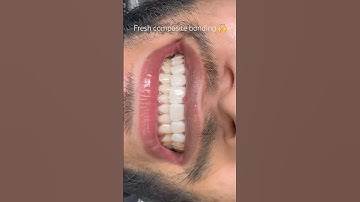 Same day composite bonding smile by Dr. Kunal 🙌 #compositebonding #smilemakeover