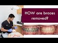 HOW are braces removed?  |  Dr. Jiten Vadukul  |  The Orthodontist