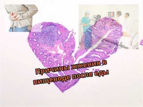 Причины жжения в пищеводе после еды