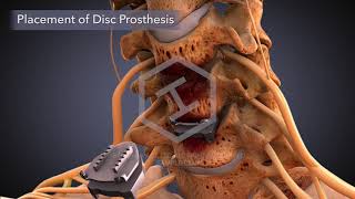 $2.25M Settlement on $8,700 Offer: Animating Cervical Disc Replacement