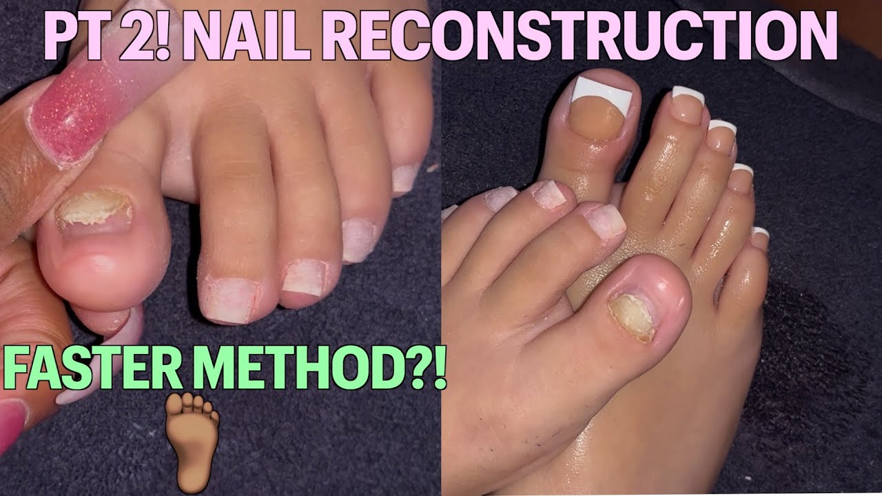 RECONSTRUCTION BIG TOENAILS PT 2 ACRYLIC TOENAIL BEFORE AND AFTER