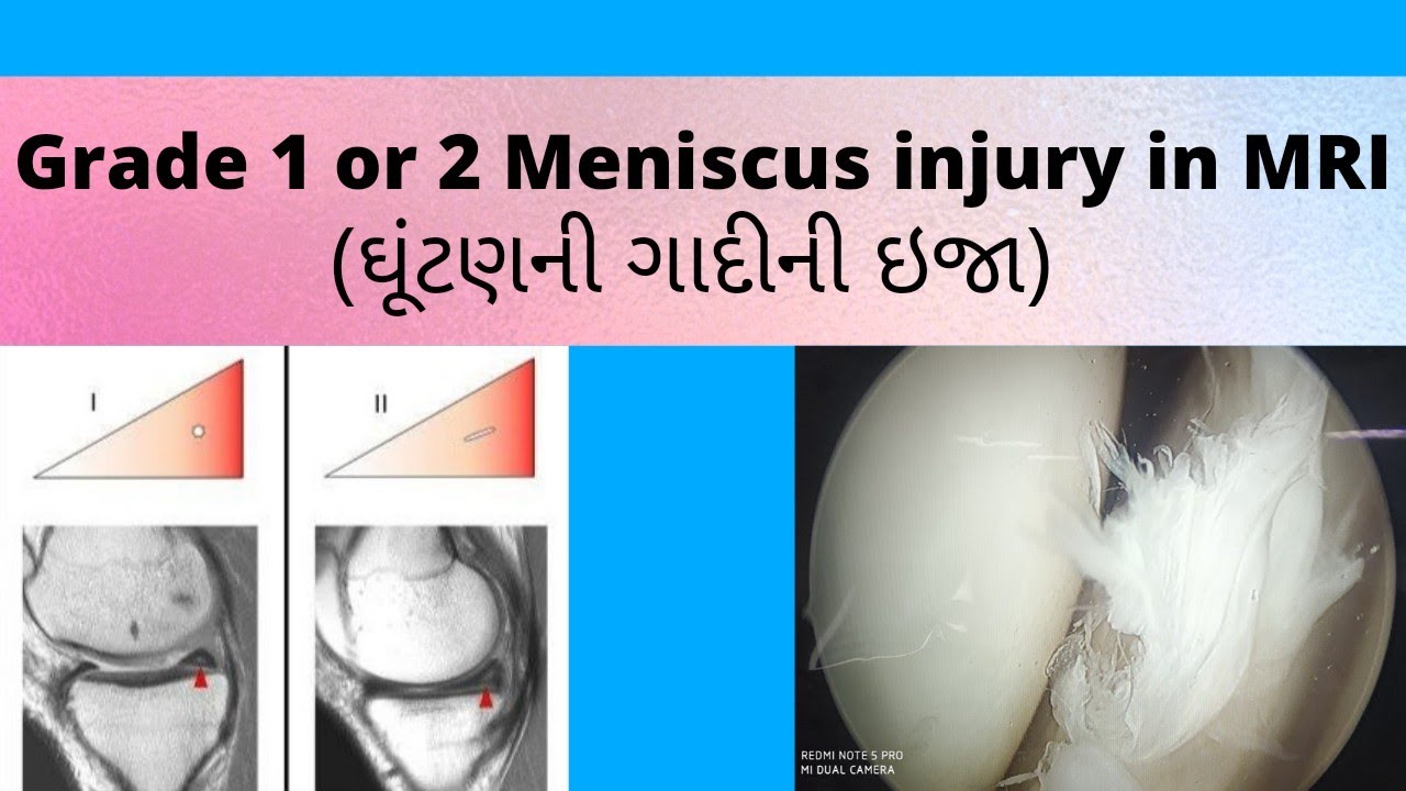 Grade 1 and Grade 2 Meniscus Tear on MRI meniscustear ઘૂંટણની ગાદીની