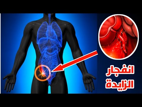 فيديو: أين تتألم عندما تتمزق الزائدة الدودية؟