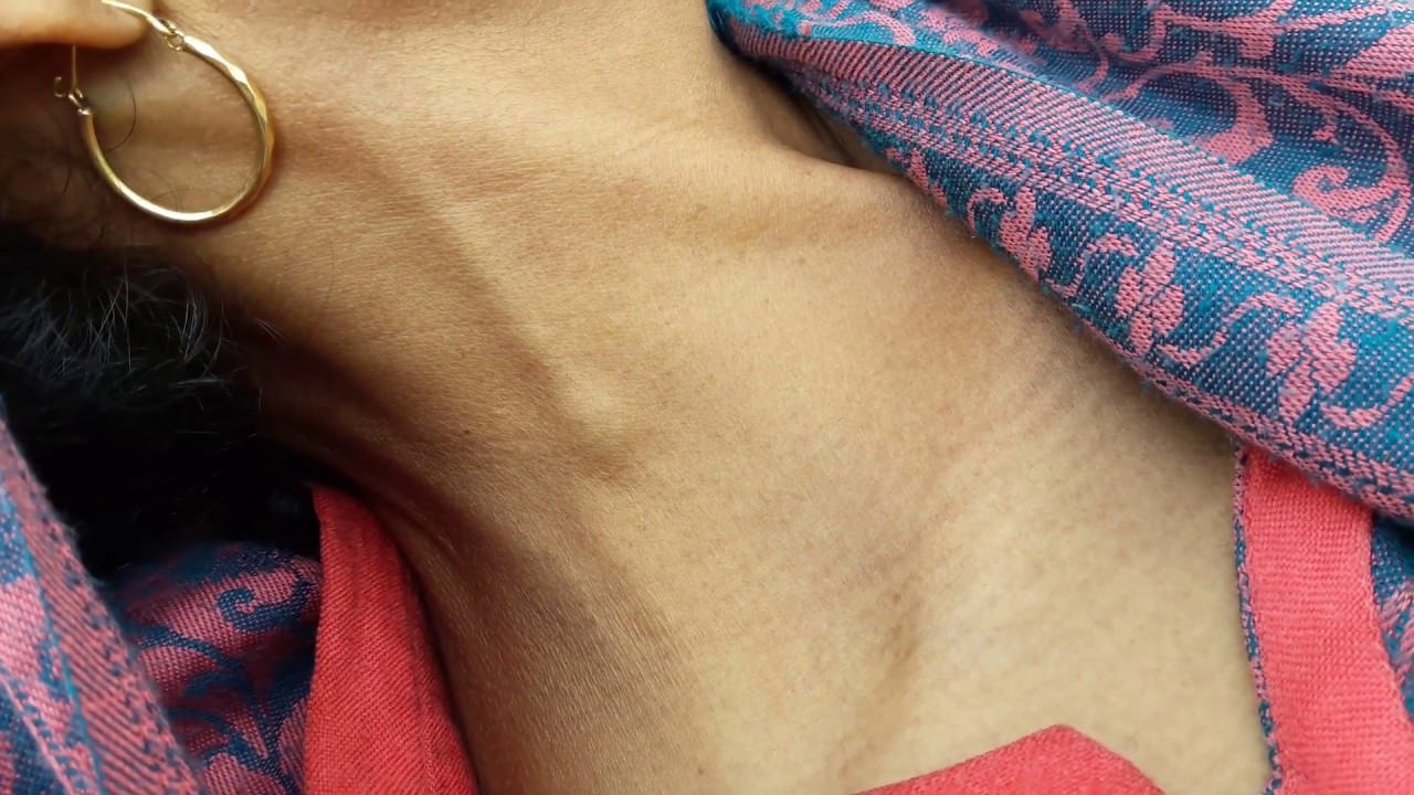 Jugular Vein Distension || Distended Veins || Raised JVP - YouTube