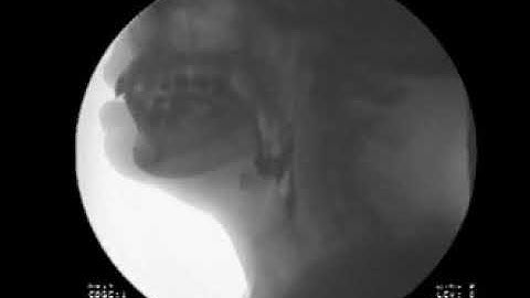Modified Barium Swallow Study - Michael Groher | MedBridge