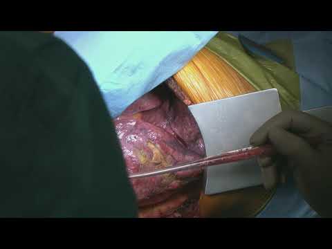 2. Thoracoabdominal aortic aneurysm repair after TAR+ET ② preparation2