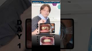 Nerve Bypass Treatment | Full Mouth Dental Implants | 6 Months Success - Dr Mayur Khairnar