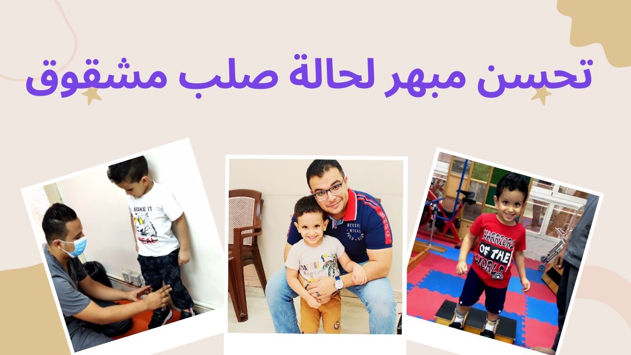 تحسن مبهر حالة صلب مشقوق والمشي بمفرده | Spina Bifida Case
