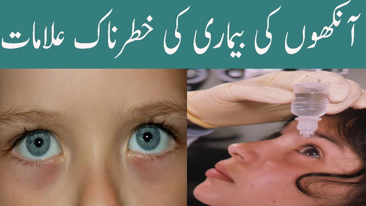 Eyes Can Say About Your Health In Urdu Eyes Infection Aankhon Ki 7