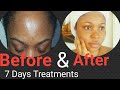 HOW I CLEARED MY ACNE SCARS NATURALLY|DIY 7 DAYS TREATMENTS | SPOTS, PIGMENTATION, SCARS TREATMENTS