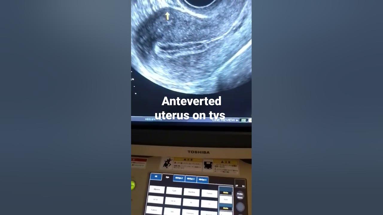 what-is-anteverted-uterus-and-how-it-s-looks-on-tvs-ultrasound-youtube