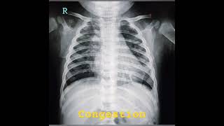 Lungs Congestion in baby child