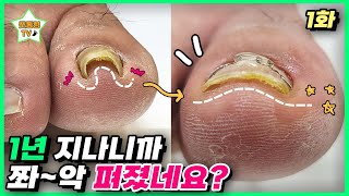 (eng sub)[1편] 1년 동안 투자한 돈이 아깝지 않아요ㅎㅎ 왕뿌듯!｜레푸스 서면점/사상점｜ingrown toenail｜Athlete&#39;s foot-Fresh Foot