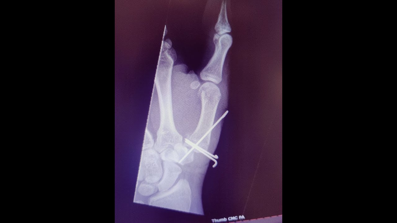 Fracture Pin Removal 3 Pins YouTube