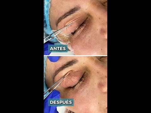 Blefaroplastia Sin Cirugía