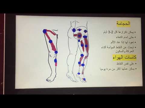 علاج عرق النسا بطرق طبيعية بدون استخدام المسكنات المسببة لتلف الكلي والكبد د.شيماء عبدالتواب