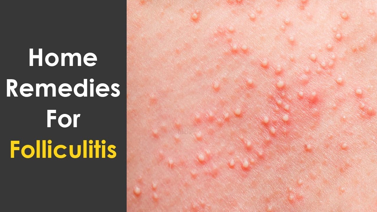 Home Remedies To Get Rid Of Folliculitis Fast Remedies For