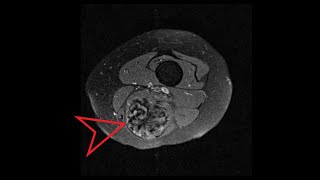 Knee MRI: Knee Mass (Tumor)