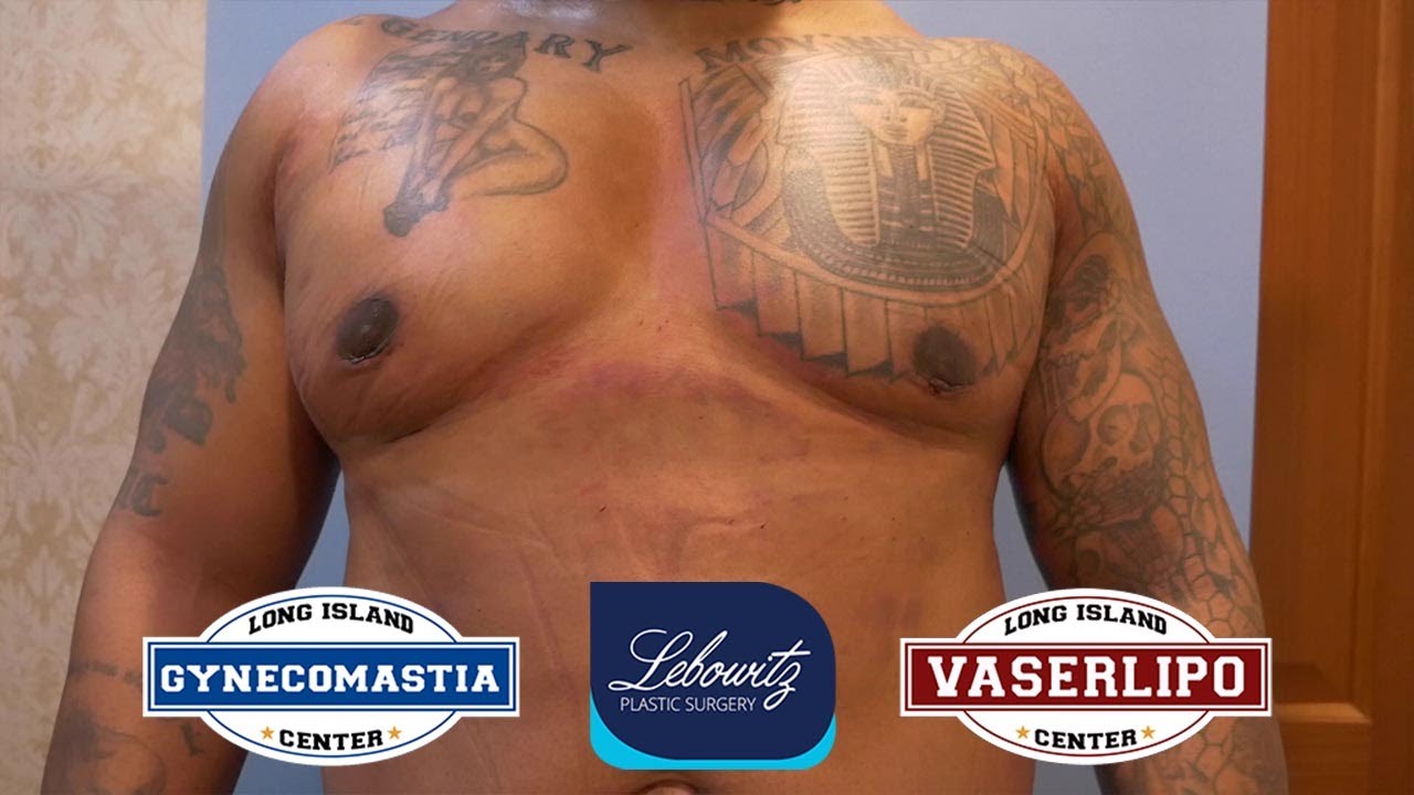 SURGERY 48 Hrs PostOp‼️Vaser Lipo, Gland Removal, Renuvion🔥PECTORAL LIPOFILLING 💪