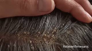 DANDRUFF SCRATCHING ITCHY SCALP !! PSORIASIS !