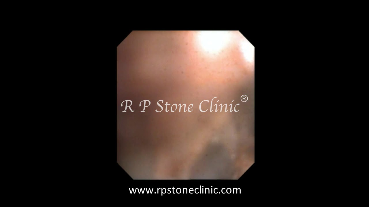Kidney Stone Lased by Holmium Laser at R P Stone Clinic YouTube