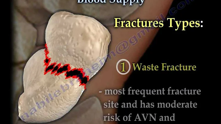 Scaphoid Fractures Blood Supply - Everything You Need To Know - Dr. Nabil Ebraheim
