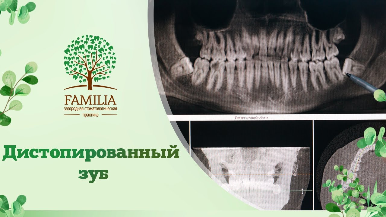 🦷 Дистопированный зуб