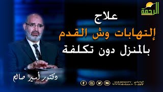 علاج إلتهابات وش القدم فى المنزل بدون تكلفة دكتور أمير صالح