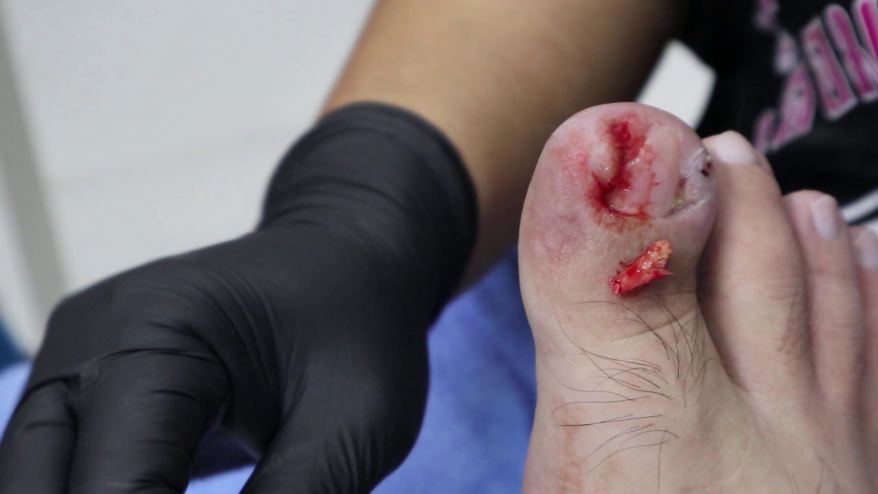 Ep_688 Big ingrown toenail removal 👣 โอ้โห... 😲  (This clip from Thailand)